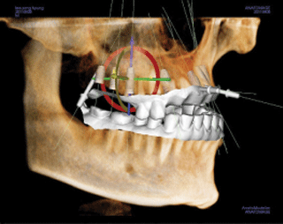 ENG05-Dental-Implant-02S-PLANT-Benefits_img_17