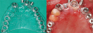 ENG05-Dental-Implant-02S-PLANT-Benefits_img_27