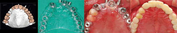 ENG05-Dental-Implant-03Dental-Implant_img01