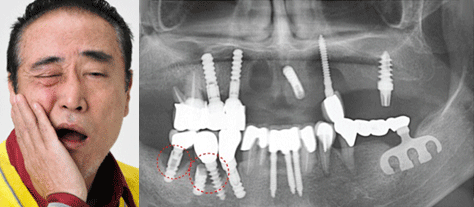 ENG05-Dental-Implant-03Dental-Implant_img05