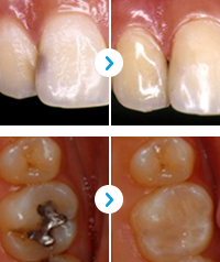 ENG09-Dental-Caries_16