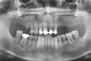 ENG05-Dental-Implant-02S-PLANT-Benefits_img_07