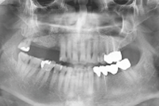 ENG05-Dental-Implant-02S-PLANT-Benefits_img_09
