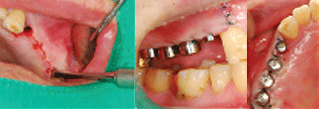 ENG05-Dental-Implant-02S-PLANT-Benefits_img_29