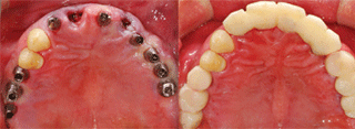 ENG05-Dental-Implant-02S-PLANT-Benefits_img_37