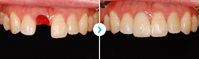 ENG05-Dental-Implant-03Dental-Implant_img02