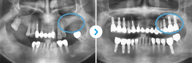 ENG05-Dental-Implant-03Dental-Implant_img03