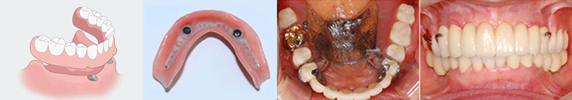 ENG05-Dental-Implant-03Dental-Implant_img04